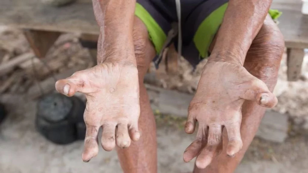Hay preocupación en México por lepra, enfermedad que afecta las manos del anciano en la fotografía