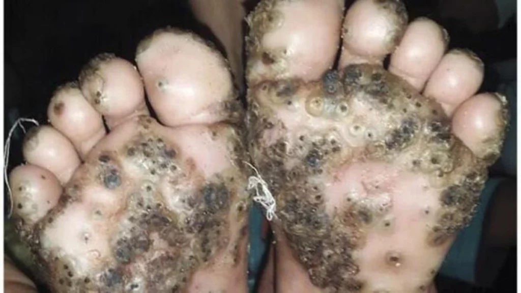 Infección en los pies de una pequeña niña, a algunos esto puede producirles tripofobia